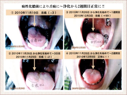 舌癌の女性の口中の画像