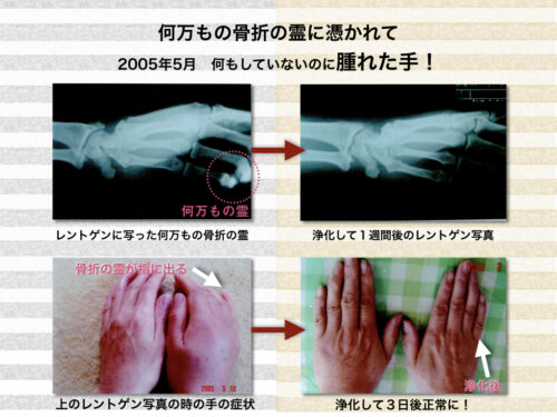 腫れた手のレントゲン画像